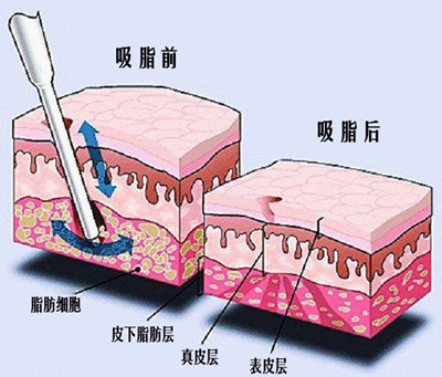 成都面部抽脂哪个医生好